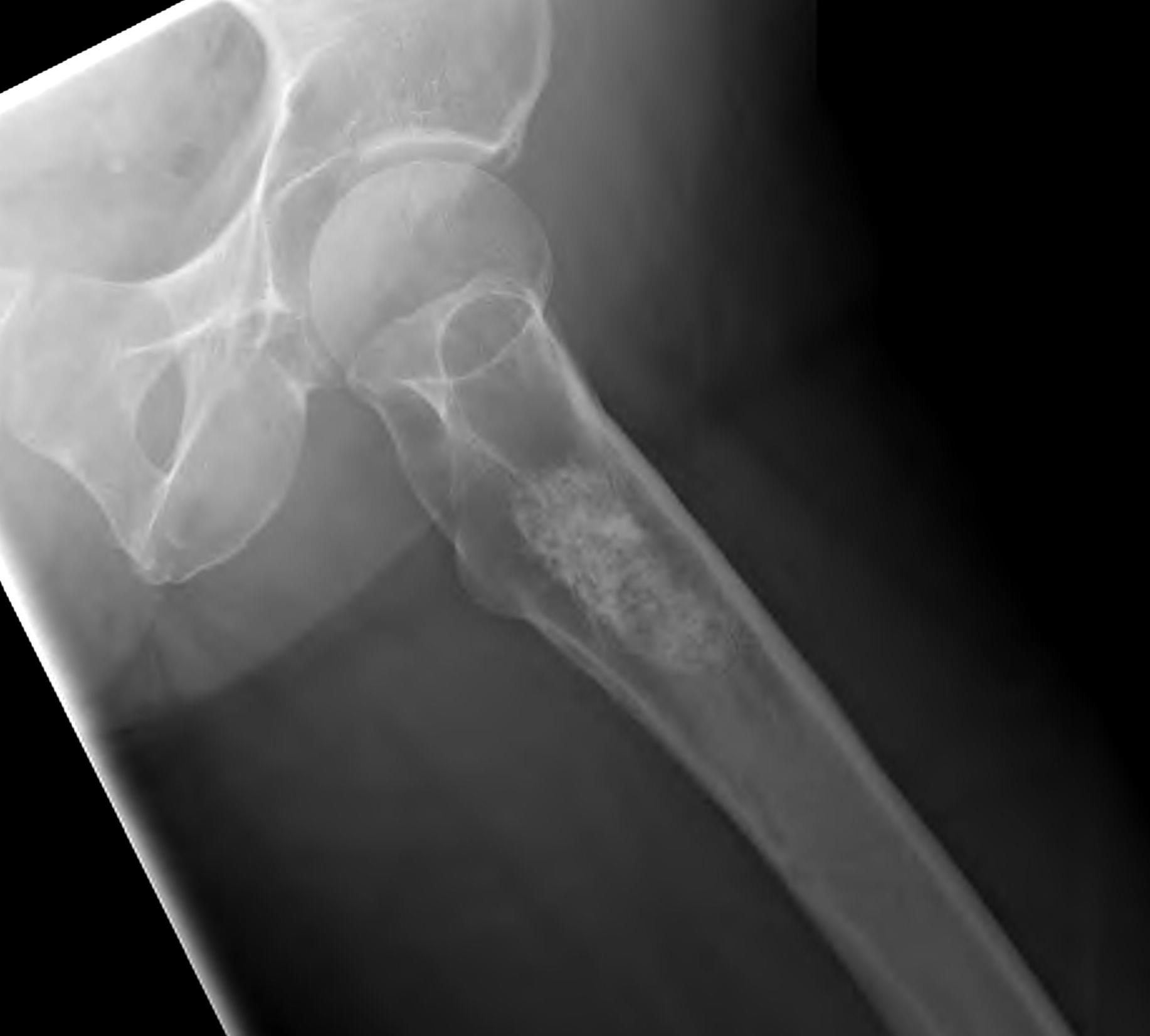 Chondrosarcoma Proximal Femur Xray0002